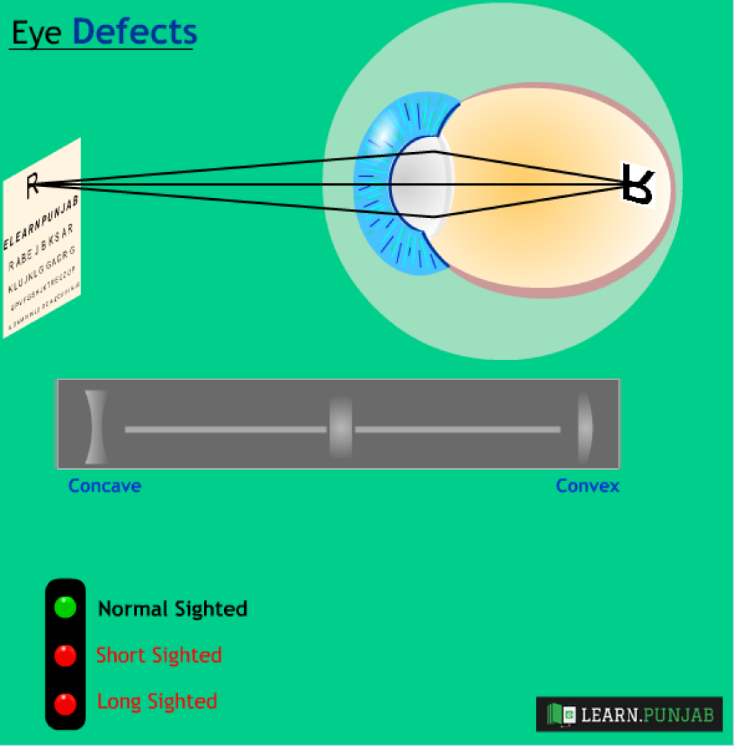Eye Defects